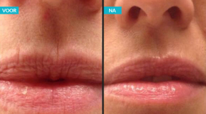 resultaat !qms lip line corrector op 3 weken met !qms behandelingen (fase3)